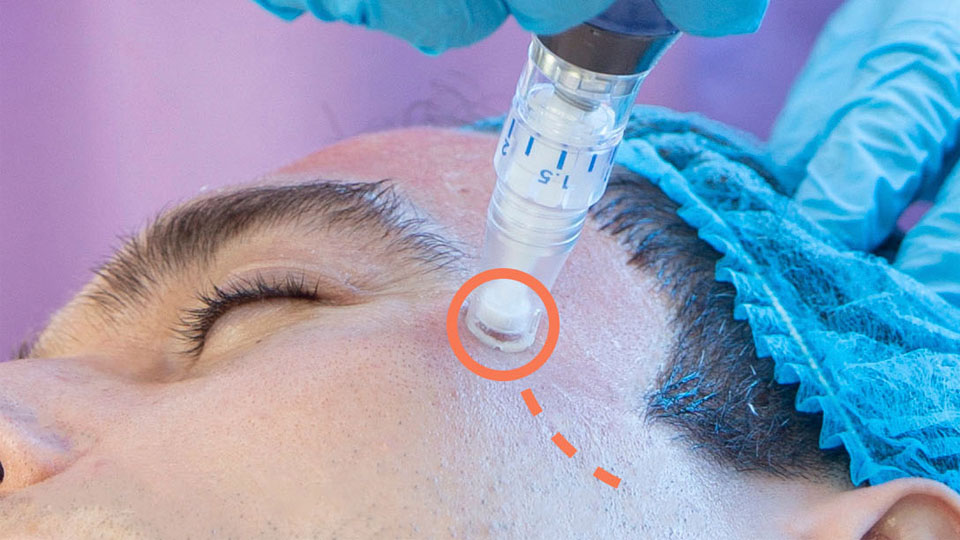 Tratamiento de mesoterapia facial