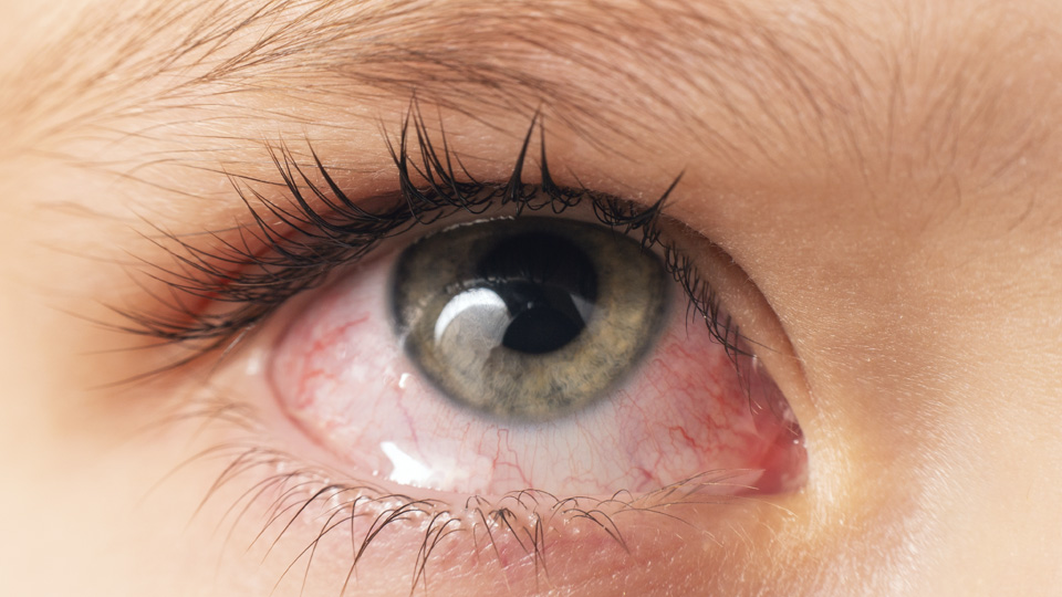 Queratoconjuntivitis vernal